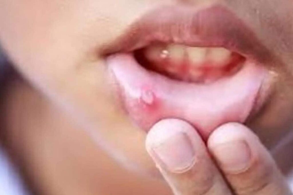 Is Mouth Ulcer Making Your Life Miserable? Here are 6 Home Remedies