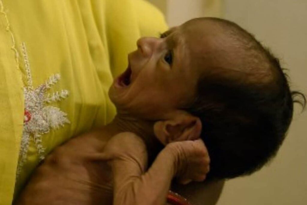 Over 33 Lakh Children in India Malnourished, 17.7 Lakh of Them in Severe Category