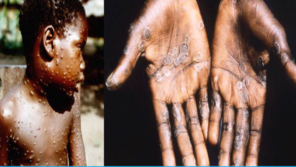 Kerala should be vigilant, officials should create awareness on Monkeypox disease: Health Minister