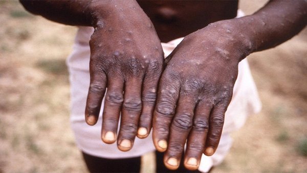 Monkeypox fear: "Keep close watch" on situation, says govt; NIV to test suspected samples