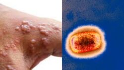 Monkeypox symptoms may reduce with antiviral drugs: Study