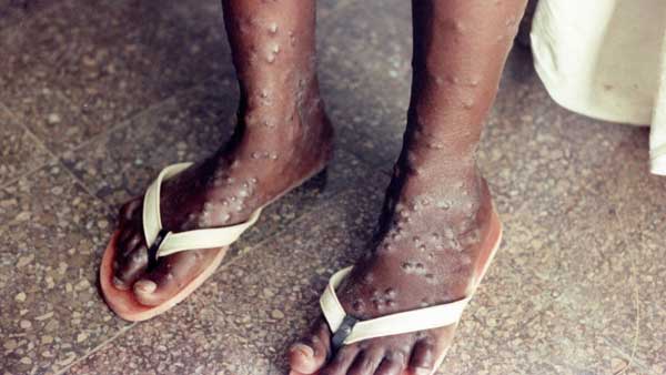 TN ups guard against Monkeypox