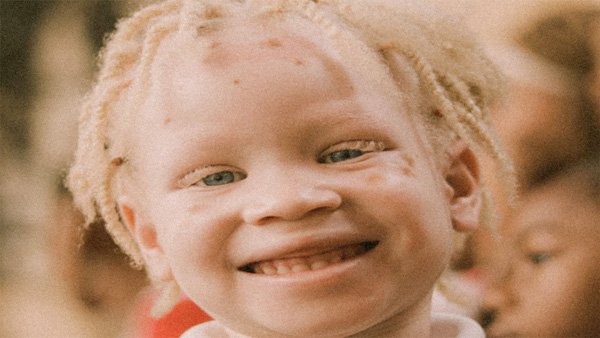 International Albinism Awareness Day: What you need to know