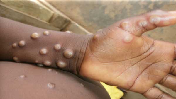 Monkeypox Updates: India confirms first case in Kerala