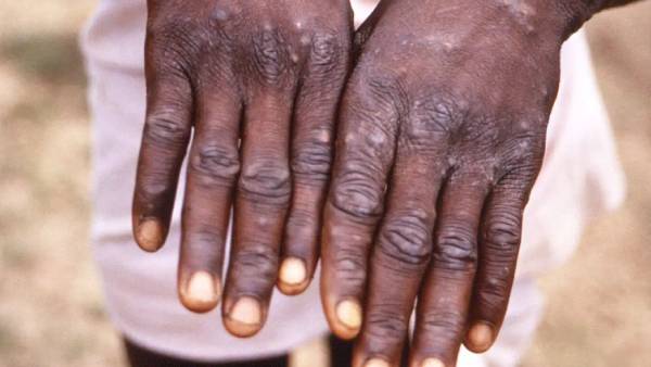 India reports third Monkeypox case in Kerala