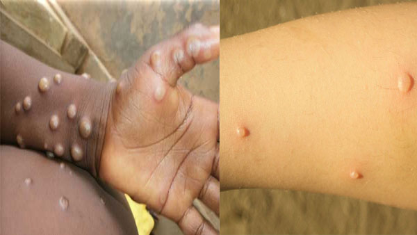 Explained: How monkeypox differs from chickenpox