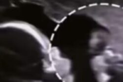In Ultrasound Footage, Baby Pokes Mom's Belly; Internet Is Stunned
