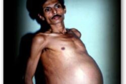 Fetus In Fetu: This Nagpur Man, Thought To Be ‘Pregnant’, Carried His Twin For 36 Years