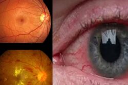 What Is Diabetic Retinopathy? All You Need To Know