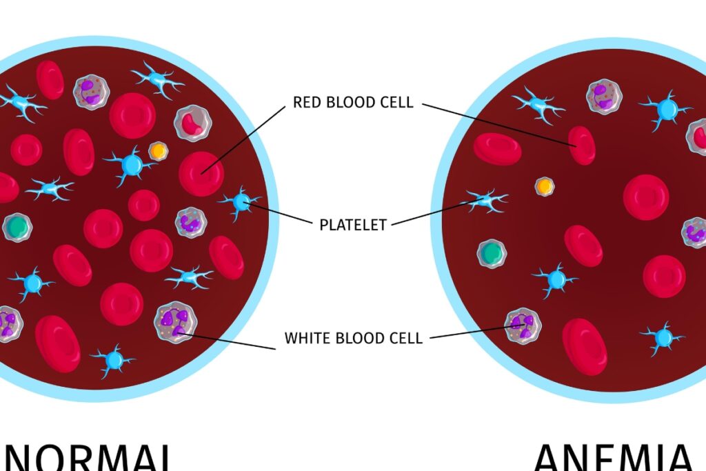 World Sickle Cell Anemia Day 2023: All You Need To Know About This Disease