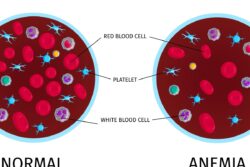 World Sickle Cell Anemia Day 2023: All You Need To Know About This Disease