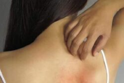 Cracked, Dry, and Itchy Skin? It Could Be Eczema