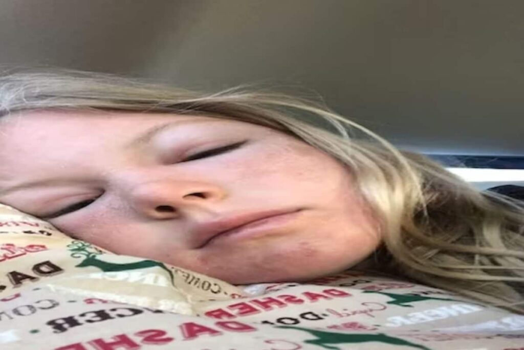 Watch: US Woman Sleeps On Beach Without Sunscreen And Turns Into An 'Alien'