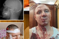 Russian Man Drills His Skull To Insert 'Dream Controlling' Chip In Brain