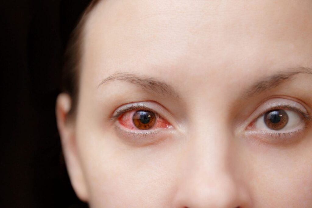 Conjunctivitis: Causes, Symptoms, Treatment and Preventive Measures