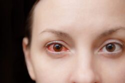 Conjunctivitis: Causes, Symptoms, Treatment and Preventive Measures