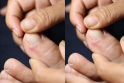 Weak Muscles To Weight Loss, Early Symptoms Of Protein Deficiency