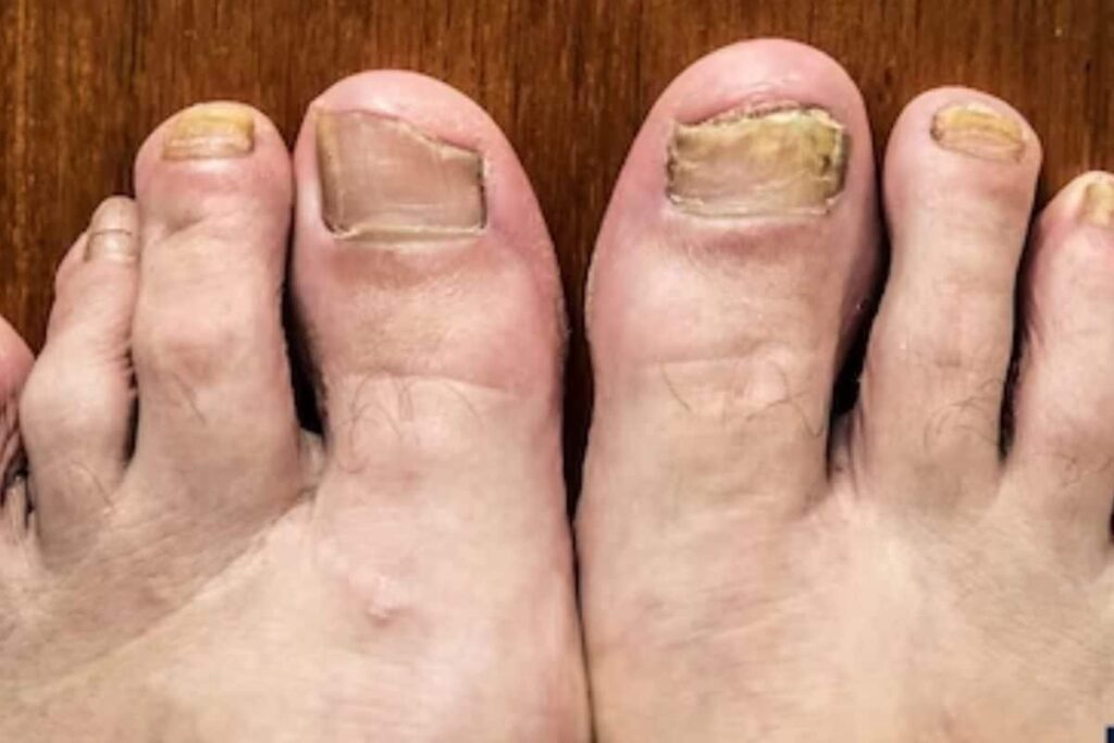 5 Antifungal Treatments To Use During the Monsoon Season