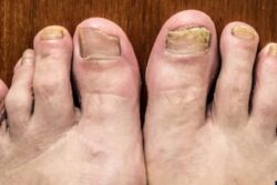 5 Antifungal Treatments To Use During the Monsoon Season