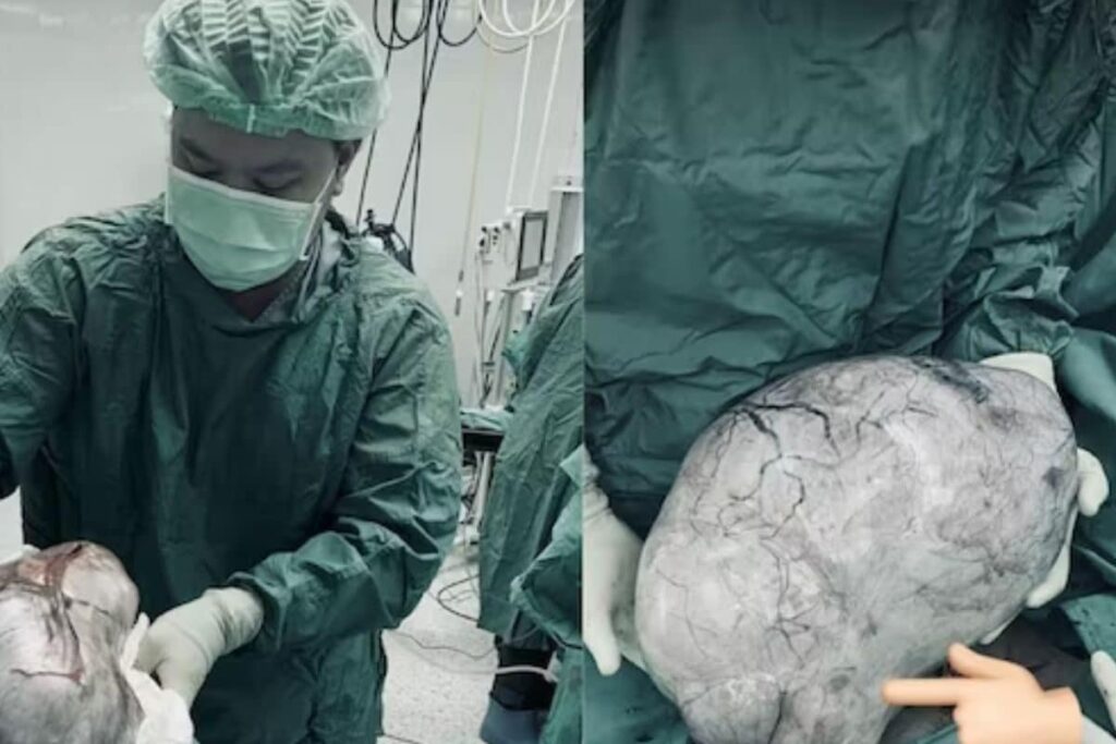 Thailand Woman Thought To Be Obese Finds Out She Has Ovarian Cyst Weighing 9 Kgs