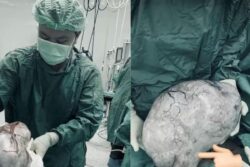 Thailand Woman Thought To Be Obese Finds Out She Has Ovarian Cyst Weighing 9 Kgs