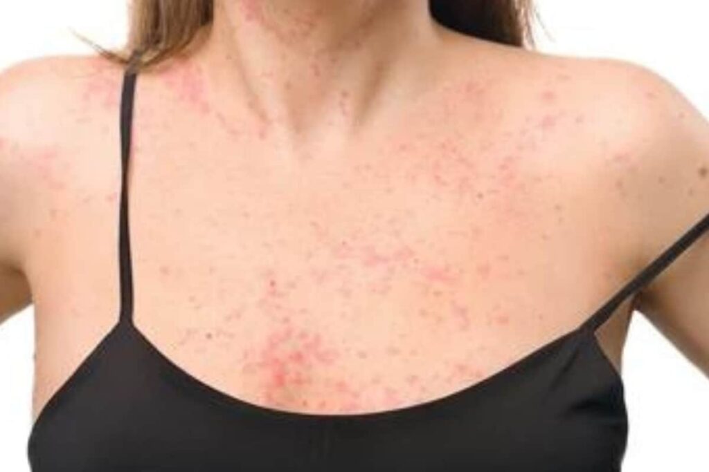 Things About Psoriasis And Its Complications That Everyone Must Know About