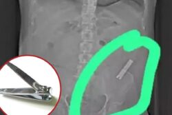 Bengaluru Doctors Remove Nail Cutter From Man’s Stomach After Eight Years