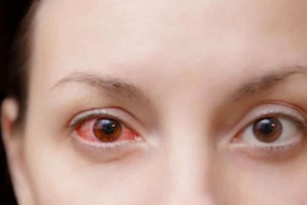 Nagaland: Three Districts Shut Schools as Conjunctivitis Cases Rise