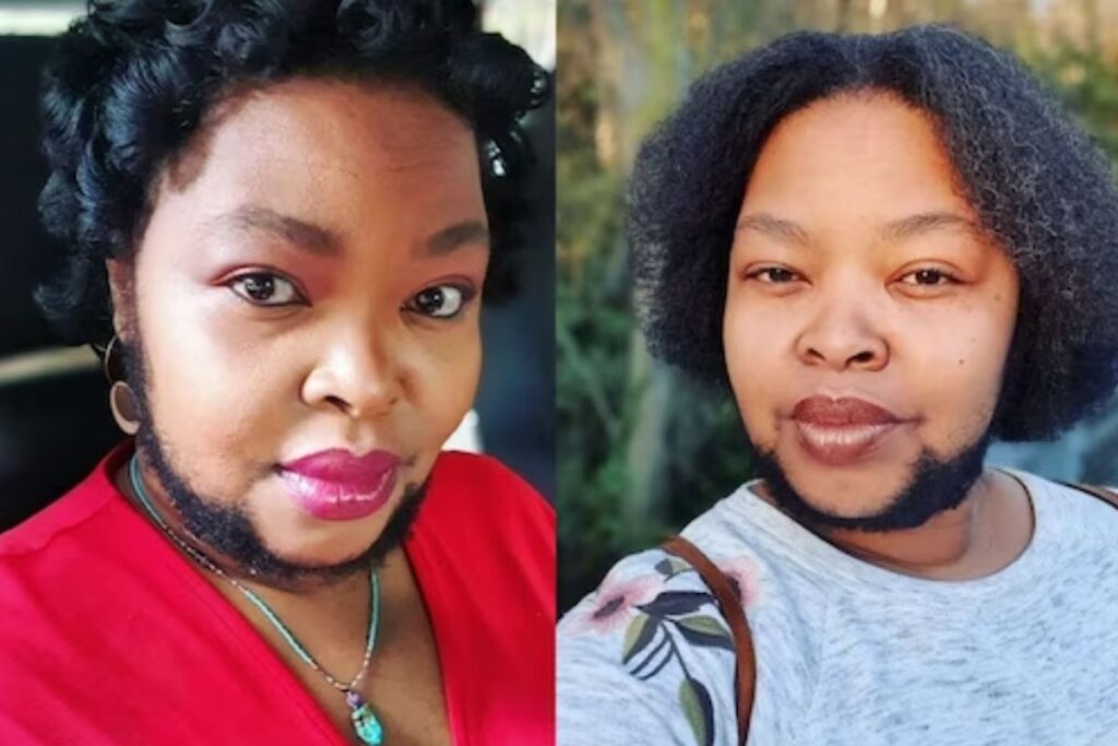 Bearded South African Woman Has A Condition Where Hair Grows Rapidly On Face And Chest
