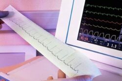 Cardiologist Explains Reasons Behind Normal ECG During Heart Attacks
