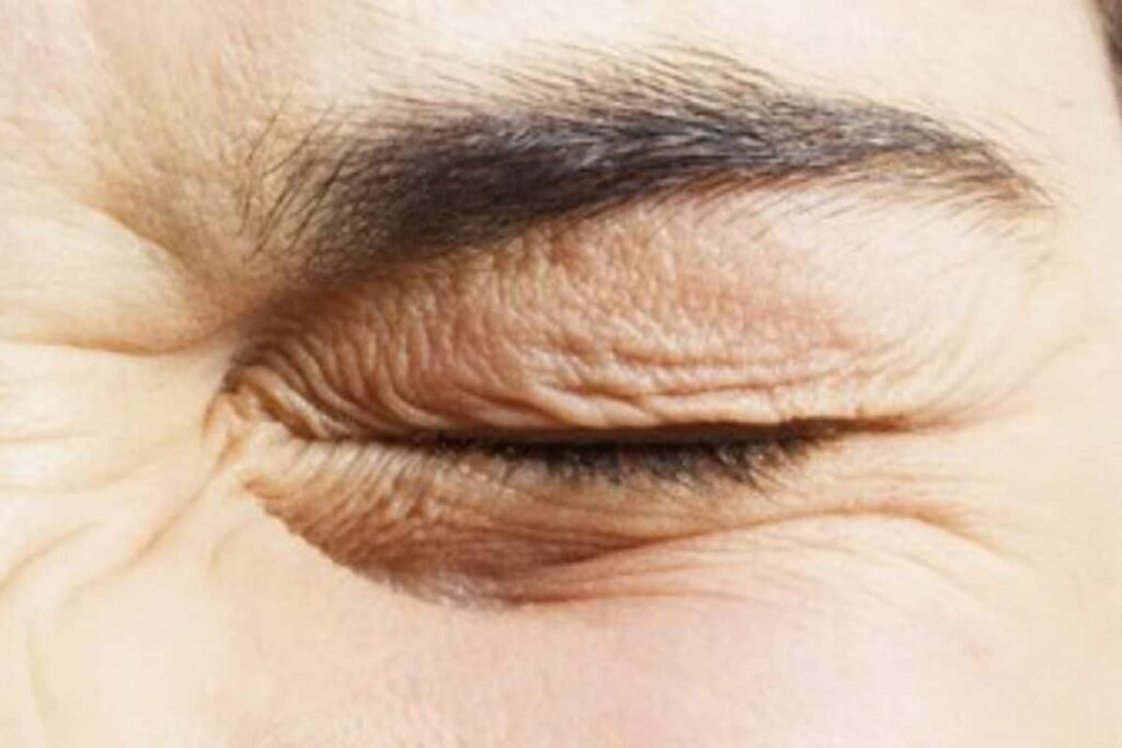 Is Eye Twitching A Serious Health Ailment? Check What Expert Says