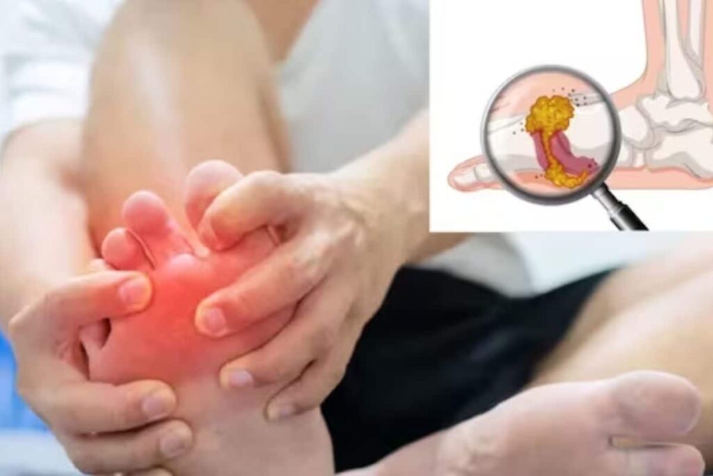 High Uric Acid: Symptoms, Causes, And Lifestyle Changes To Prevent It