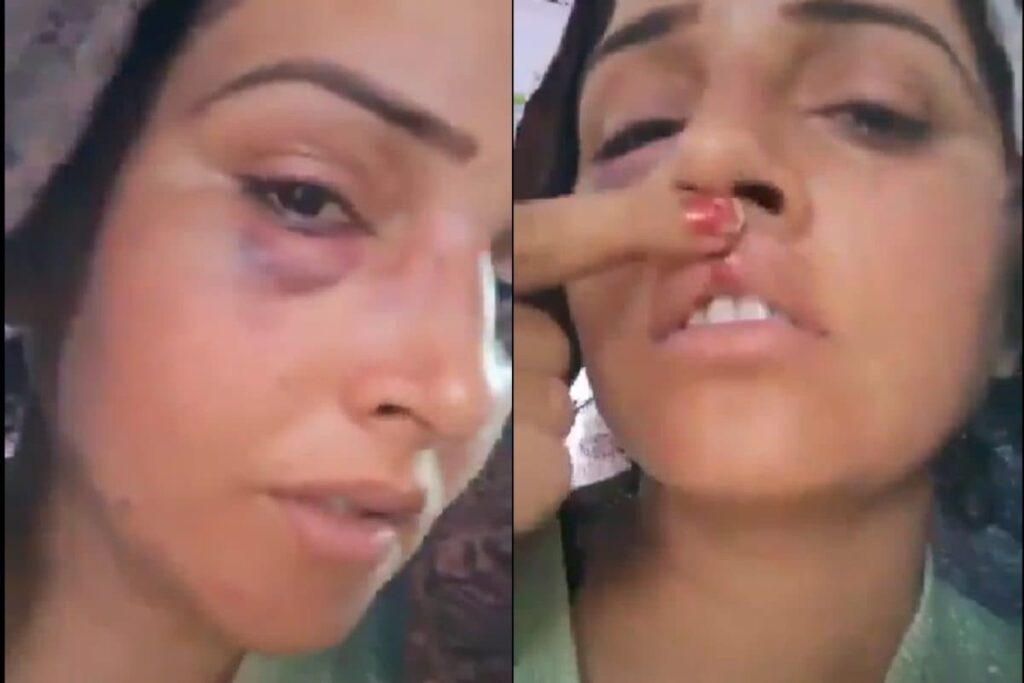 Seema Haider Shows Swollen Eye, Lip Injury In Viral Video. Did Husband Sachin Beat Her? Here's What Happened