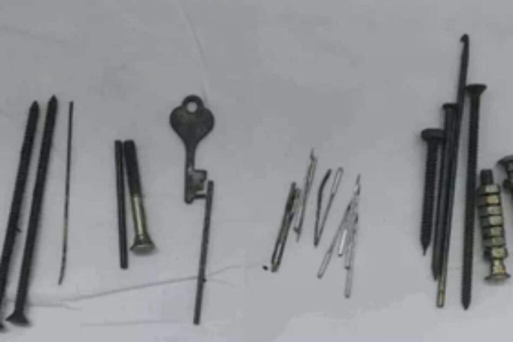 Jaipur: Nails, Needles, Nuts, And Bolts Removed From Man's Stomach During Surgery