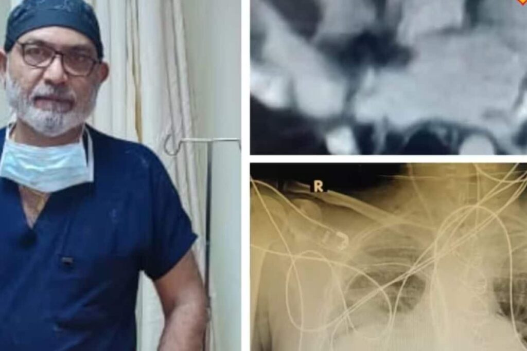 48-Year-Old Coimbatore Man Lives With Two Beating Hearts After Heterotopic Transplantation