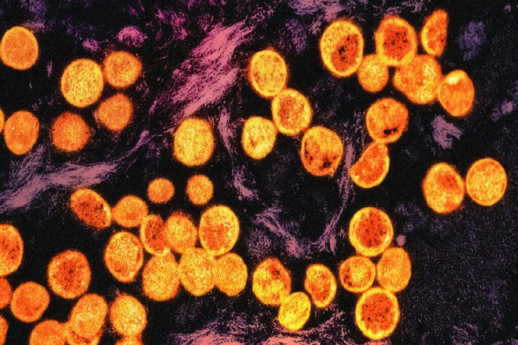 Gurugram Health Department Issues Mpox Alert, Health Officials Urge Caution; No Cases Reported Yet