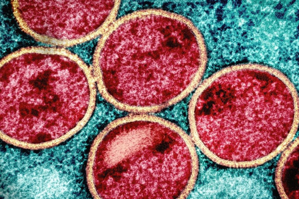 Isolated Patient Who Returned From Abroad Tests Positive For Mpox In India’s First Case