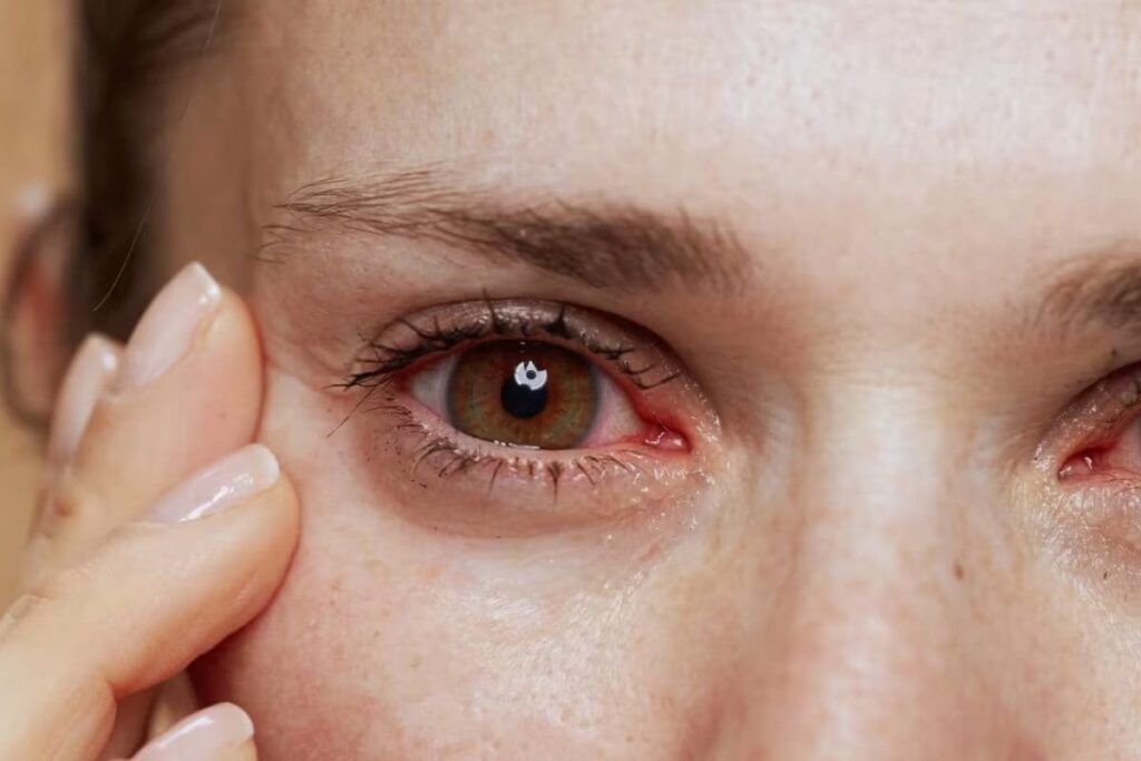 WHO Felicitates India for Elimination of Trachoma as Public Health Problem