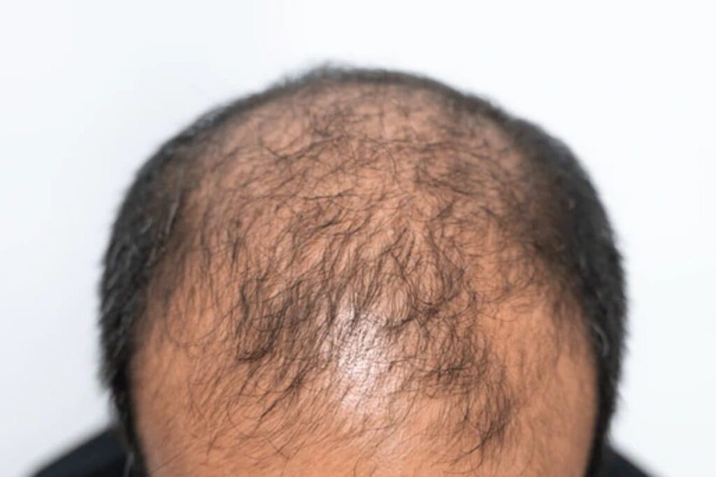 Sudden Hair Loss, Baldness In These Villages Of Maharashtra Sparks Panic; Authorities Testing Water