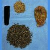 In Rare Surgery, Doctors Unburden 70-Year-Old Gurugram Man Of 8,000 Gallstones