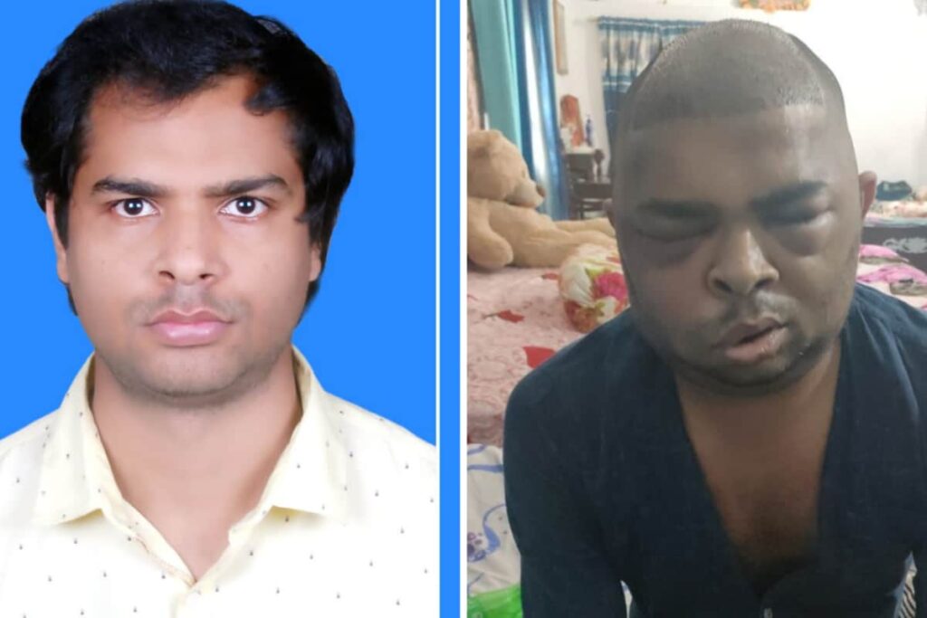 Is A New Hairline Worth Your Lifeline? Inside Kanpur's Growing Epidemic Of Botched Transplants