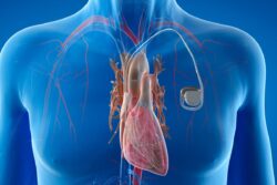 Advanced Procedure Gives New Lease Of Life To 47-Year-Old Who Suffered Repeated Cardiac Arrests