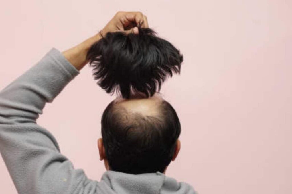 Angered By ‘Jija Ji’ Screaming At Sister, UP Man ‘Pulls Out’ Patch Of His Hair