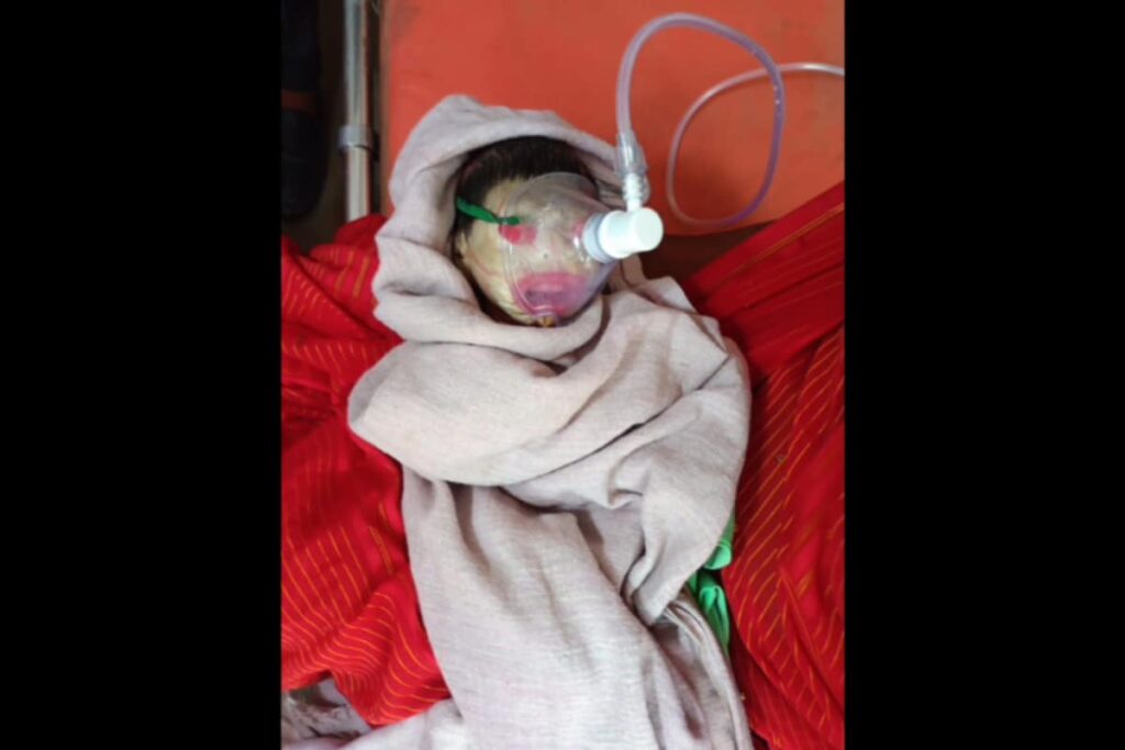 Collodion Baby: Newborn With Rare Skin Condition Admitted To ICU In MP's Rewa