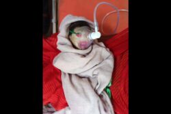 Collodion Baby: Newborn With Rare Skin Condition Admitted To ICU In MP's Rewa