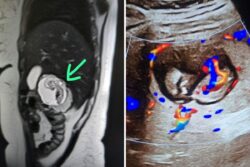 UP Woman’s Foetus Growing In Liver, Not Uterus: What Is Rare Intrahepatic Ectopic Pregnancy?