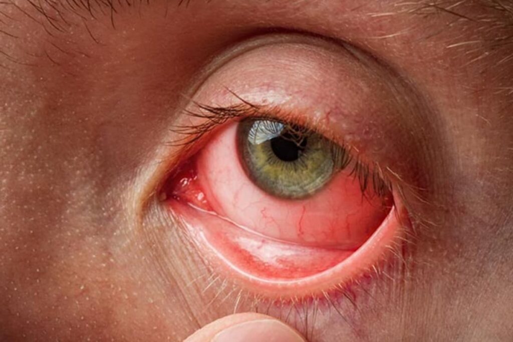 Delhi-NCR Sees Unusual Surge In ‘Eye Flu’ Cases This Monsoon With Longer Recovery Time