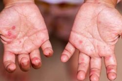 Tomato Flu Outbreak Among Kids Raises Concern In Uttarakhand, 28 Cases Confirmed