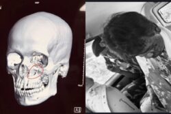 'Could Have Lost Vision': BJP Claims Khagen Suffered Fracture Below Eye In Stone-Pelting Attack