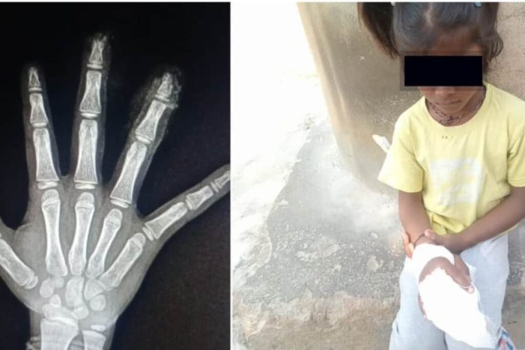Karnataka Girl's Fingers Severed In School, Parents Say Staff Discarded Them